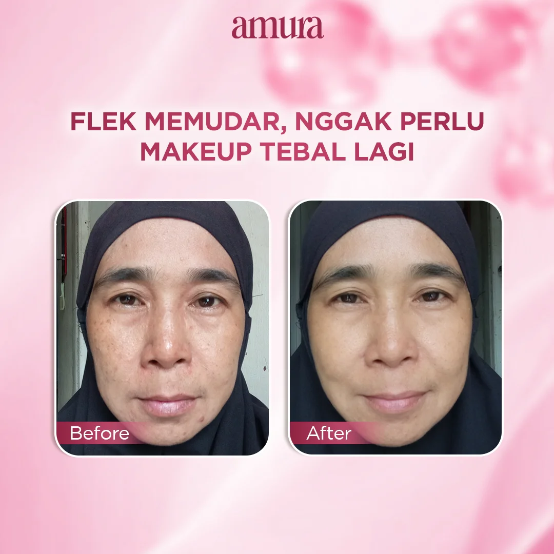 Ilustrasi Nyata Hasilnya Wajah Tampak Lebih Bersih untuk Amura Spotless Radiance Dark Spot Treatment solusi Ampuh untuk Fl...
