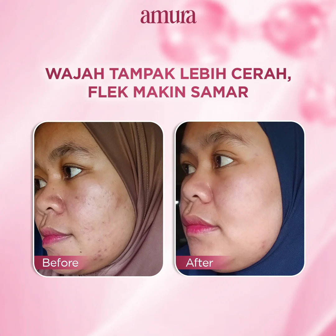 Ilustrasi Nyata Hasilnya Wajah Tampak Lebih Bersih untuk Amura Spotless Radiance Dark Spot Treatment solusi Ampuh untuk Fl...