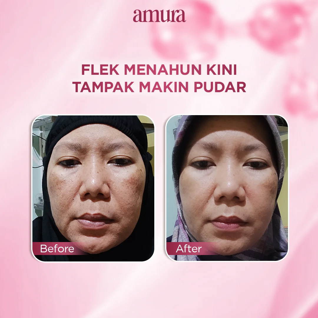 Ilustrasi Nyata Hasilnya Wajah Tampak Lebih Bersih untuk Amura Spotless Radiance Dark Spot Treatment solusi Ampuh untuk Fl...